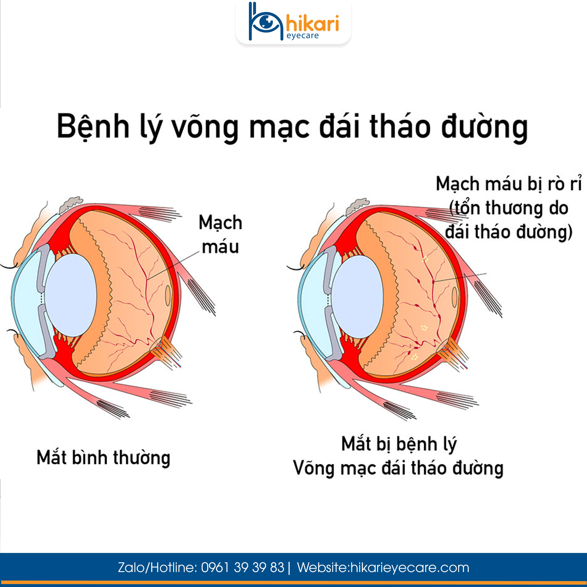 Đồ họa thông tin mô tả chi tiết cơ chế rò rỉ dịch của mạch máu đáy mắt bị tổn thương do biến chứng tiểu đường so với mắt bình thường.