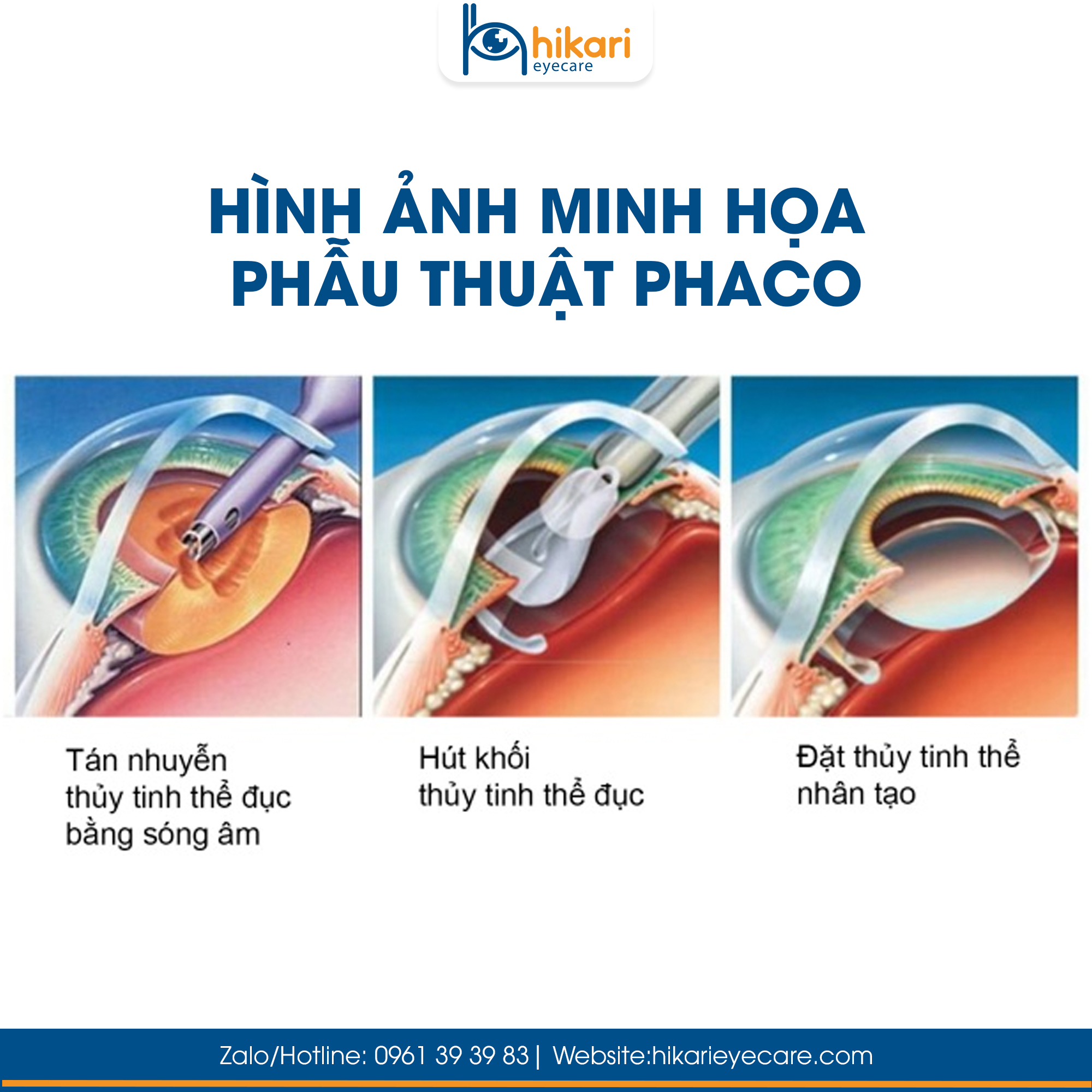 Sơ đồ 3 bước phẫu thuật Phaco gồm tán nhuyễn, hút khối thủy tinh thể đục và đặt thủy tinh thể nhân tạo