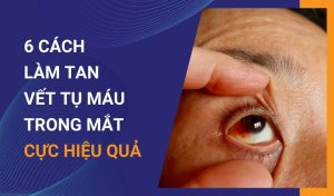 6 cách làm tan vết tụ máu trong mắt cực hiệu quả