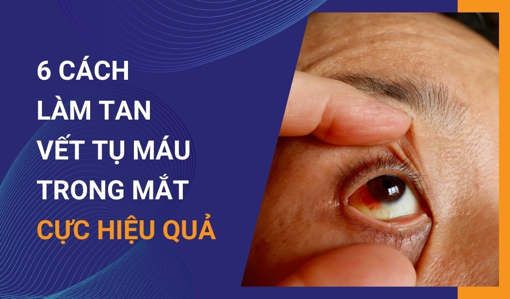 6 cách làm tan vết tụ máu trong mắt cực hiệu quả