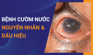 Bệnh cườm nước (Glaucoma) là gì Dấu hiệu và nguyên nhân