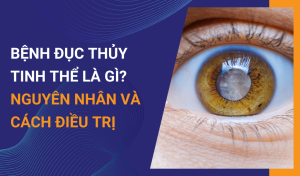 Bệnh đục thủy tinh thể là gì Nguyên nhân do đâu
