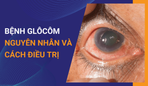 Bệnh glôcôm mắt là gì Triệu chứng và cách phòng tránh bị bệnh Glocom ở mắt
