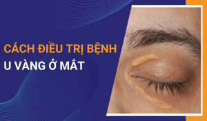 Bệnh u vàng mi mắt (Xanthelasma) và cách điều trị hiệu quả