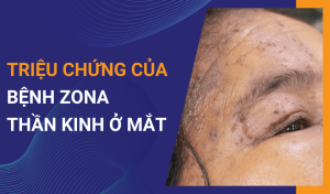 Bệnh zona thần kinh ở mắt Triệu chứng và cách điều trị hiệu quả