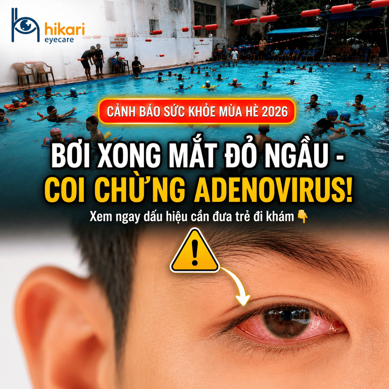 Trẻ em đi bơi và bị mắt đỏ sau khi bơi, cảnh báo nguy cơ viêm kết mạc do Adenovirus với dấu hiệu cần đưa trẻ đi khám sớm.