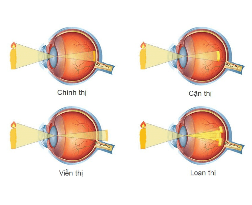Có 4 loại tật khúc xạ phổ biến hiện nay_ cận thị, viễn thị, lọan thị và lão thị