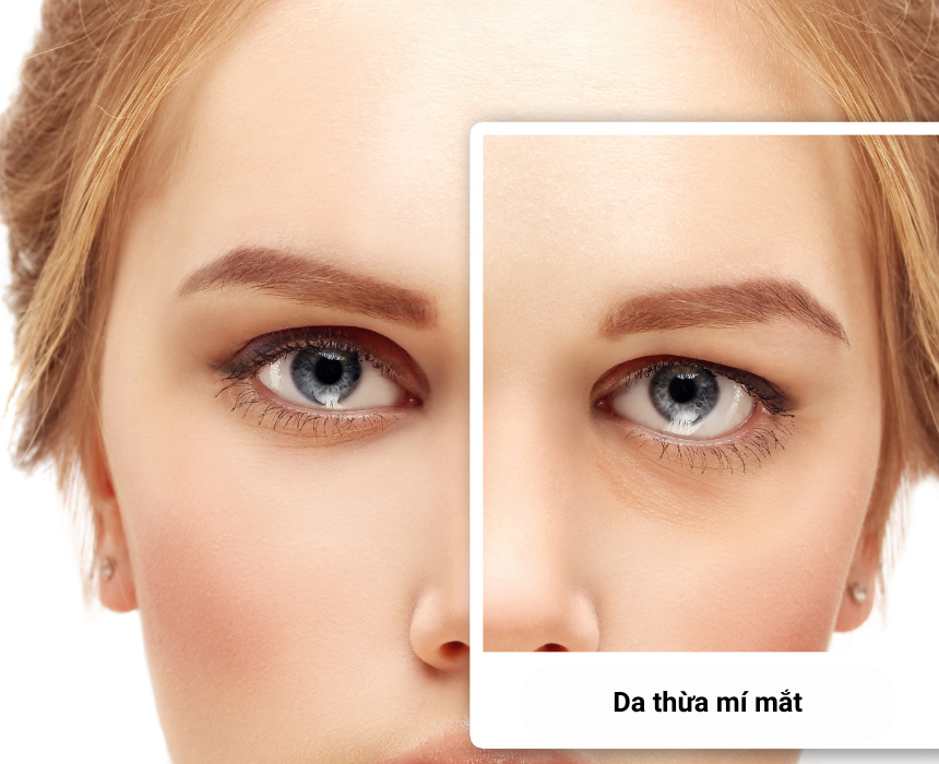 Da thừa mí mắt, còn được gọi là sa da mí mắt, là hiện tượng dư thừa tổ chức da và mô dưới da ở khu vực mí trên