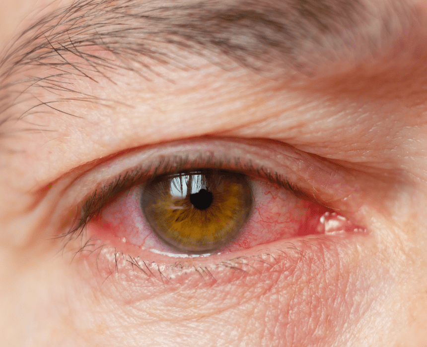 Đau mắt đỏ là tình trạng mắt bị viêm kết mạc, thường xảy ra khi thời tiết thay đổi hoặc chuyển mùa