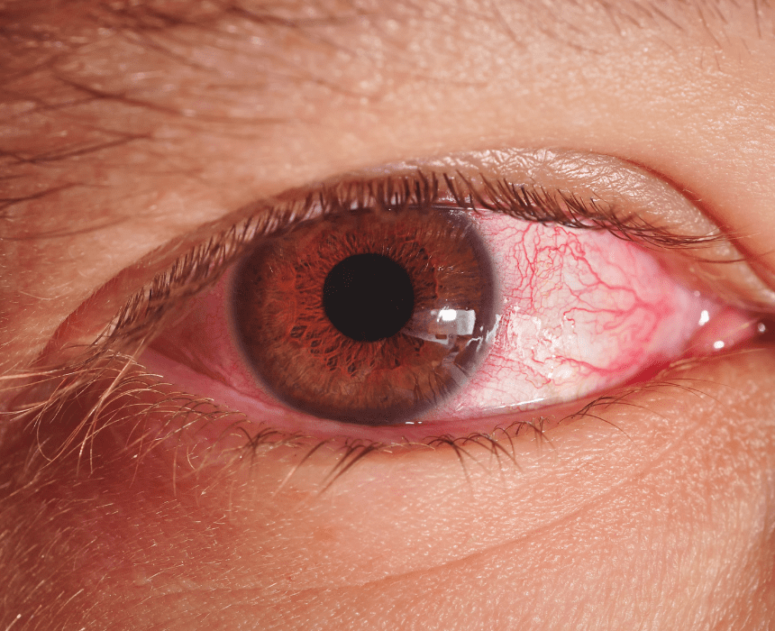 Đau mắt đỏ là tình trạng mắt bị viêm kết mạc, xuất hiện phổ biến vào đầu mùa hạ đến cuối thu