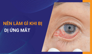 Dị ứng mắt là gì Các triệu chứng thường gặp và biện pháp phòng tránh