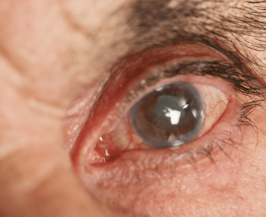 Đục thủy tinh thể gây ra các tình trạng như mờ mắt, suy giảm thị lực,