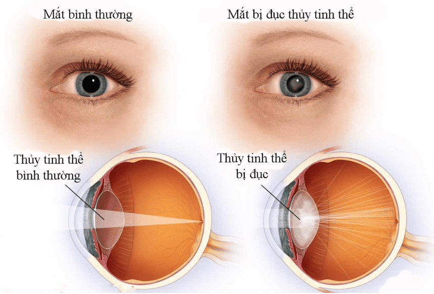 Giảm thị lực là triệu chứng quan trọng nhất của bệnh đục thủy tinh thể