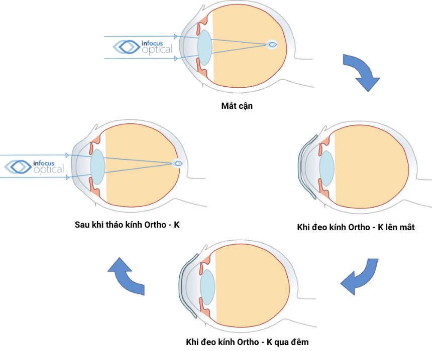 Kính áp tròng cứng (Kính Ortho - K) được sử dụng để điều chỉnh các vấn đề liên quan tới tật khúc xạ