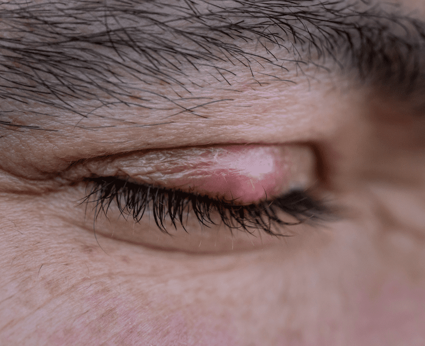 Lẹo mắt là tình trạng tuyến dầu nhỏ bị tắc ở đáy mí mắt, thường do nang lông mi bị nhiễm trùng