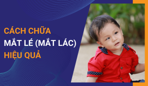 Mắt lé (Mắt lác) là gì Nguyên nhân và cách điều trị hiệu quả