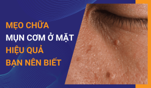 Mẹo chữa mụn cơm ở mặt hiệu quả bạn nên biết