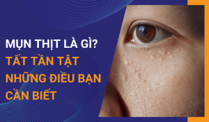 Mụn thịt là gì Tất tần tật những điều bạn cần biết