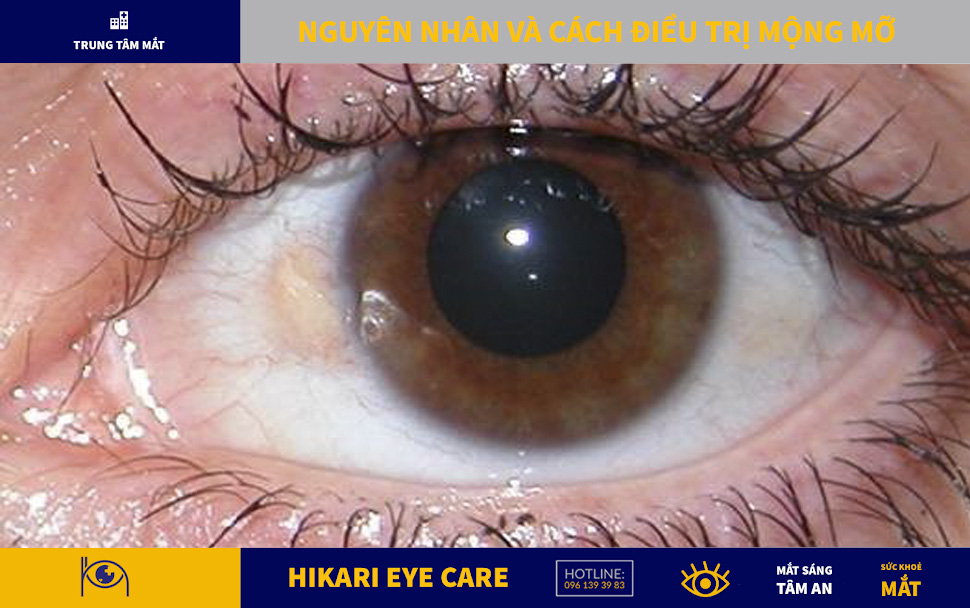 Thông Tin Nhãn Khoa - Hikari Eye Care