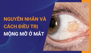 Nguyên nhân và cách điều trị mộng mỡ ở mắt