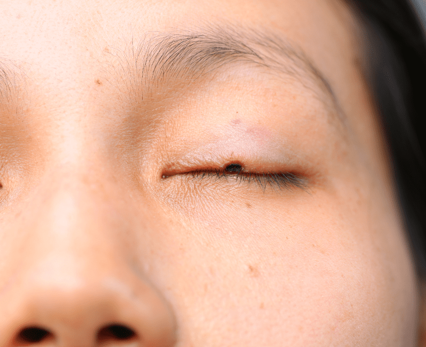 Nốt ruồi ở mí mắt thường mọc ngay vùng bờ mi, ở da mi nhưng hiếm khi ở kết mạc mi