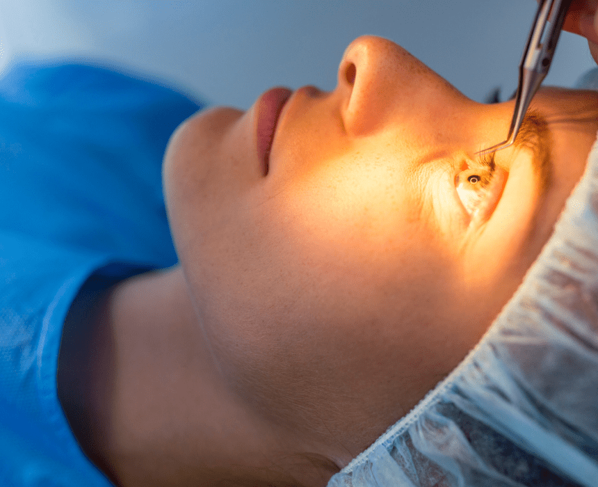 Phẫu thuật LASIK điều trị bằng cách dùng dao vi phẫu tạo vạt giác mạc