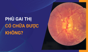 Phù gai thị có chữa được không