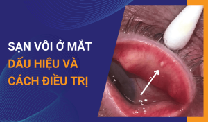Sạn vôi ở mắt là gì Dấu hiệu và cách phòng ngừa