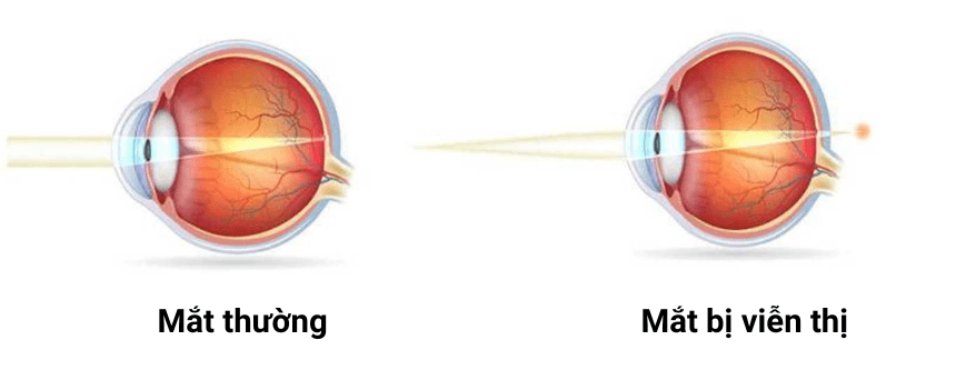 Sự khác nhau của mắt thường và mắt bị tật viễn thị khi ánh sáng đi vào mắt