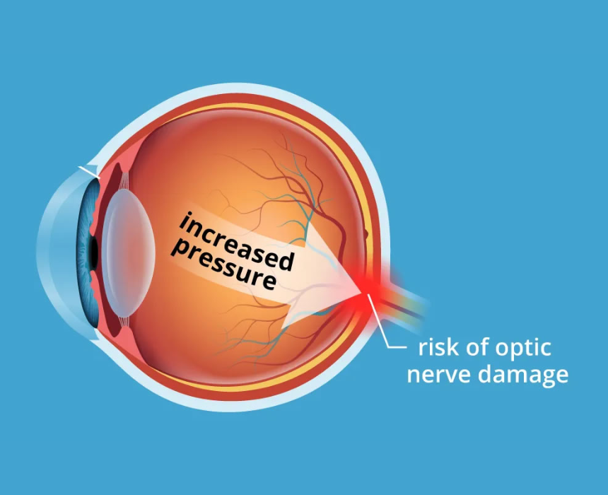 Tăng nhãn áp là thuật ngữ y học chỉ áp lực của thủy dịch bên trong mắt tăng cao hơn mức bình thường