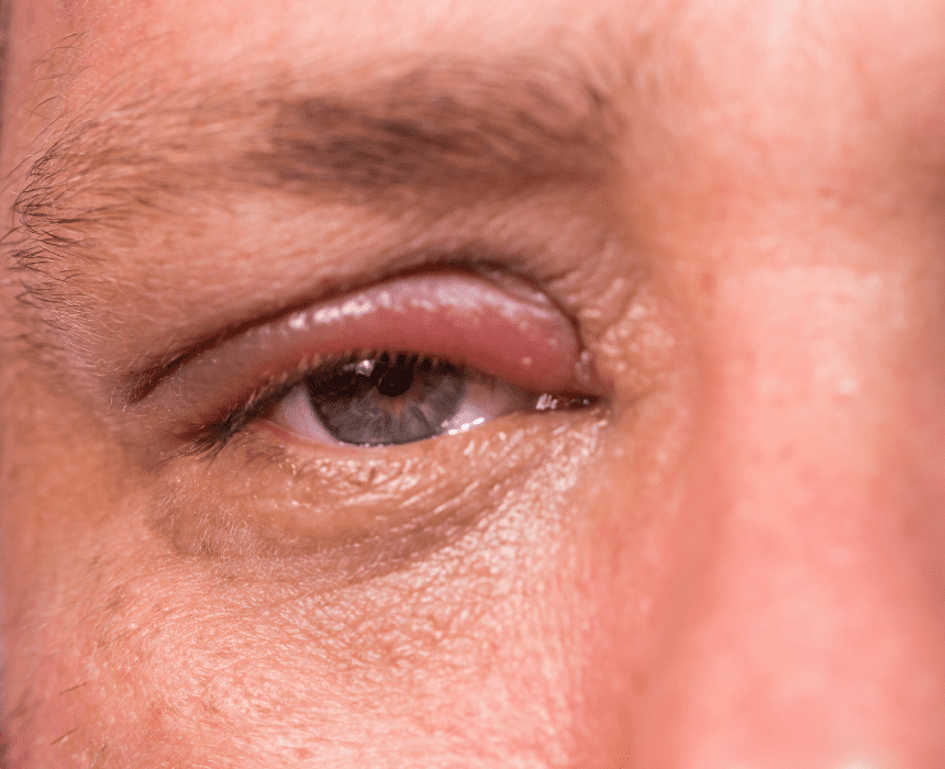 Viêm bờ mi là một chứng rối loạn mãn tính của mí mắt, mô tả tình trạng viêm của nang lông mi