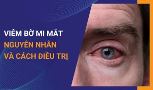 Viêm bờ mi mắt Nguyên nhân, triệu chứng và cách điều trị