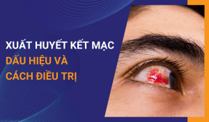 Xuất huyết kết mạc là gì Có nguy hiểm không và cách chữa trị