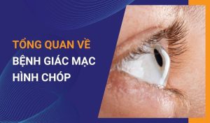 Bệnh giác mạc hình chóp là gì