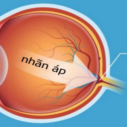 Bệnh Glocom mắt là gì ? Triệu chứng và cách phòng tránh bị bệnh Glocom ở mắt