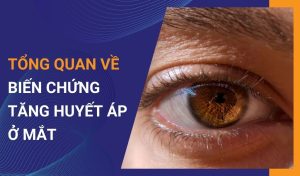 biến chứng tăng huyết áp ở mắt
