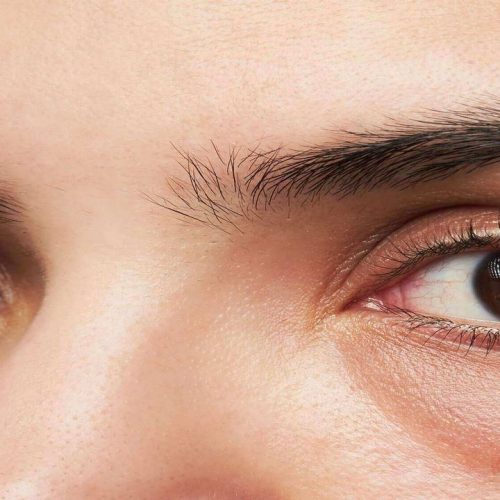 Bọng mắt là gì? Nguyên nhân và cách điều trị khi bị bọng mắt