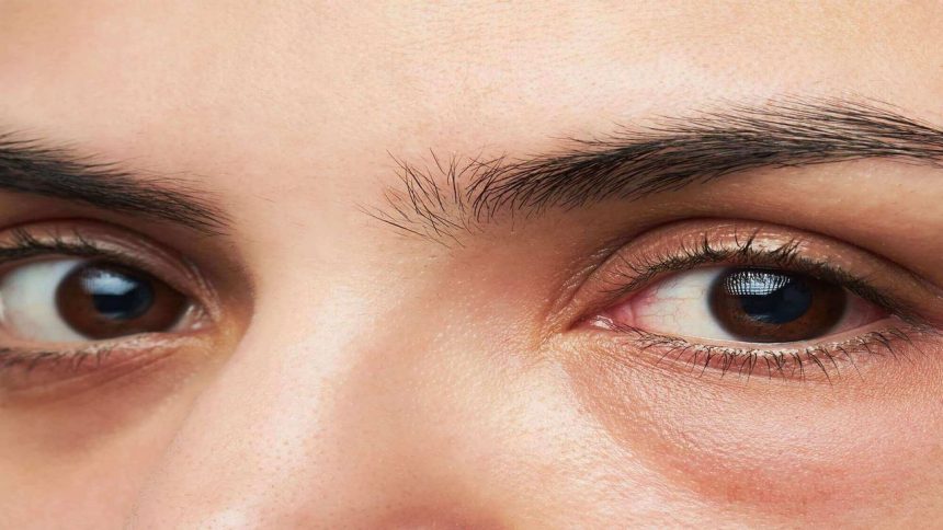 Bọng mắt là gì? Nguyên nhân và cách điều trị khi bị bọng mắt