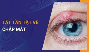 Chắp mắt là gì phân biệt chắp mắt và lẹo mắt như thế nào