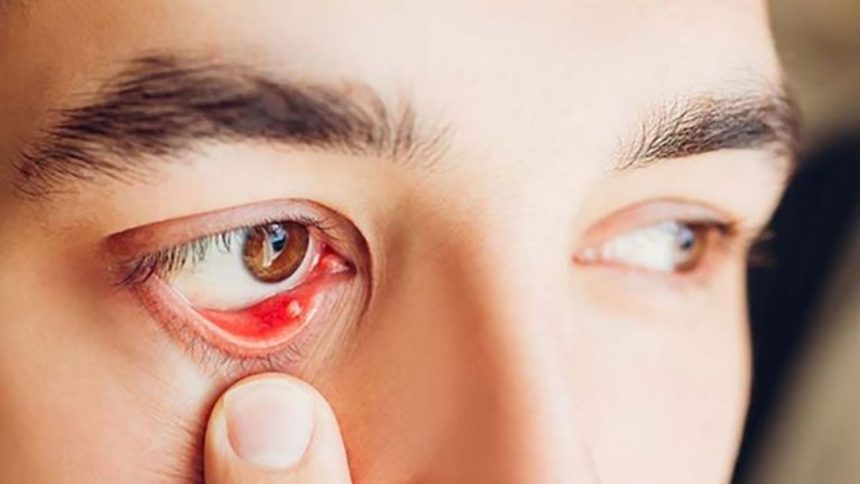 Bệnh đau mắt hột là gì? Nguyên nhân, triệu chứng mắc phải và cách điều trị