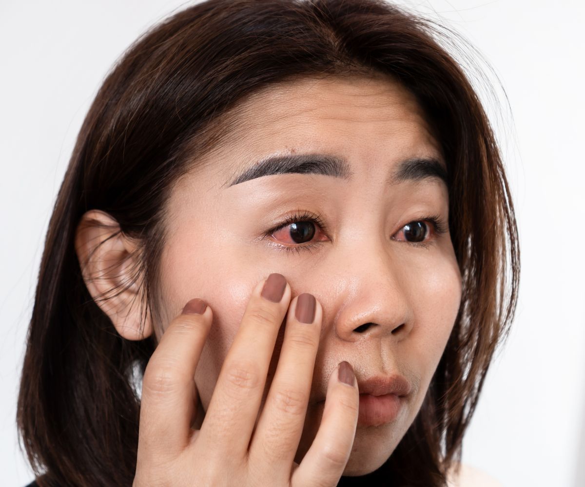 dị ứng mắt có thể gây đỏ, ngứa và chảy nước mắt