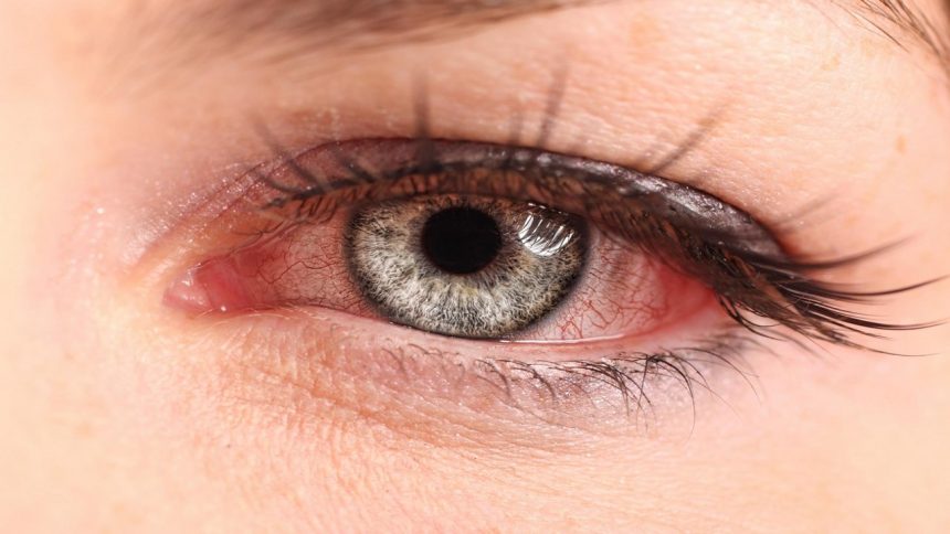 Dị ứng mắt là gì? Các triệu chứng thường gặp và biện pháp phòng tránh