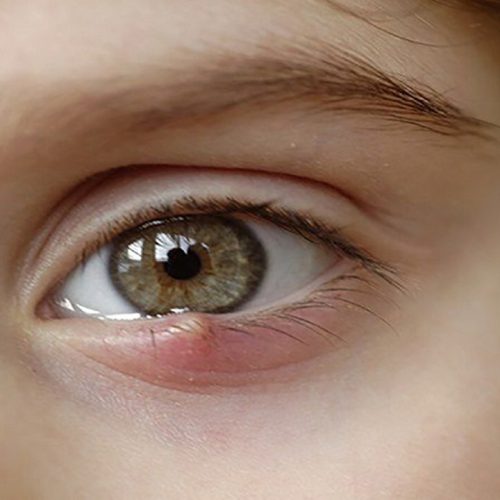 Lẹo mắt là gì ? Các nguyên nhân và cách phòng ngừa lẹo mắt