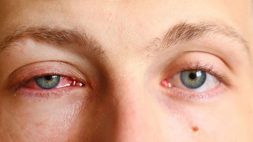 Mắt đỏ là gì? Nguyên nhân và cách khắc phục khi bị mắt đỏ