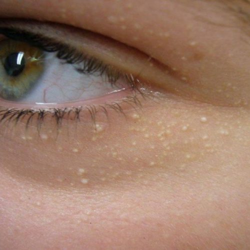 Mụn cơm ở mắt là gì? Dấu hiệu nhận biết,cách phòng ngừa