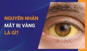 Nguyên nhân khiến mắt bị vàng là gì
