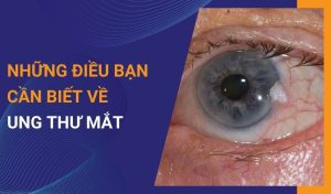 những điều bạn cần biết về ung thư mắt
