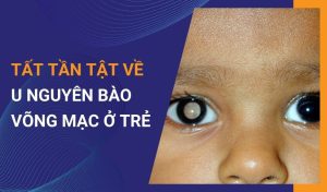Những điều cha mẹ nên biết về u nguyên bào võng mạc ở trẻ