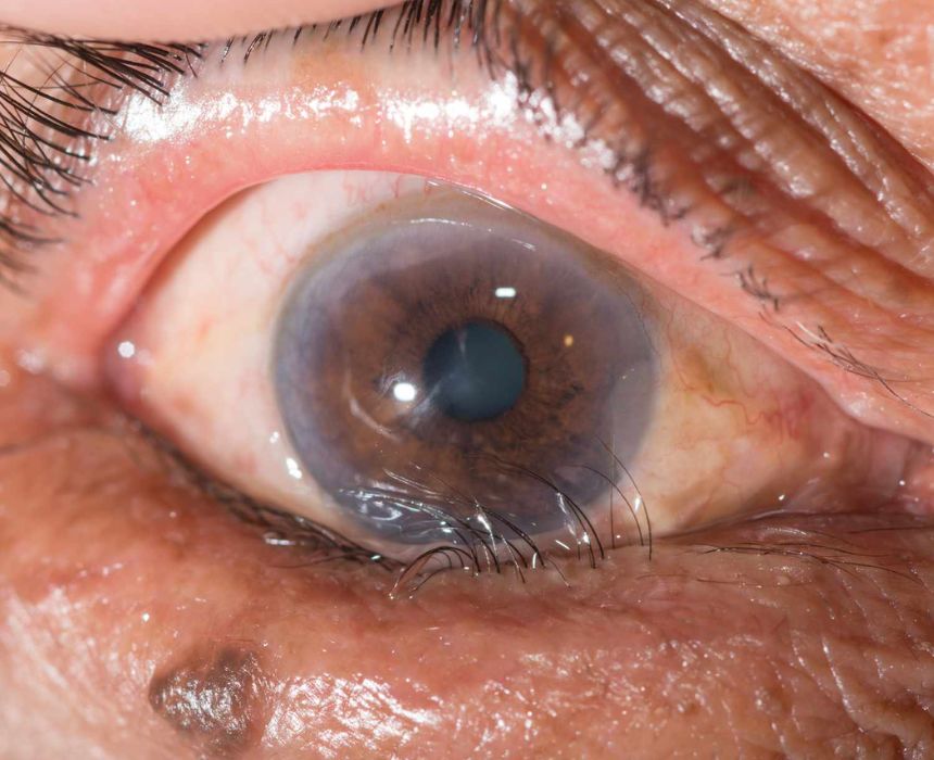 Quặm mi do lão hóa là một trong những nguyên nhân chính gây ra tình trạng này ở người lớn