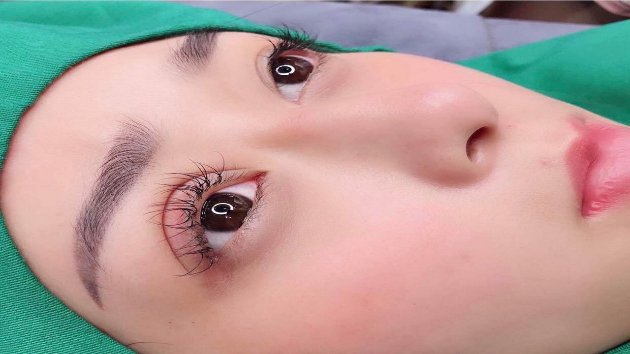 Quá trình phục hồi sau khi cắt mí mắt kéo dài bao lâu?